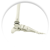 Total Ankle Replacement